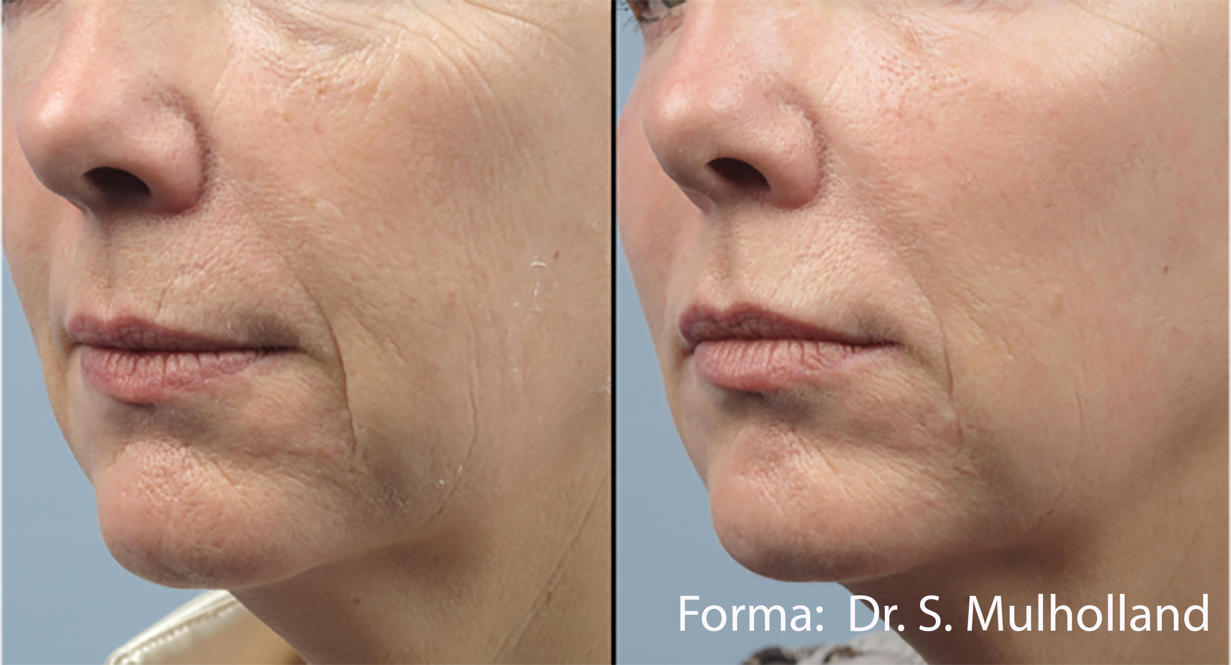 Forma Skin Tightening, Noninvasive, Stimulates Collagen