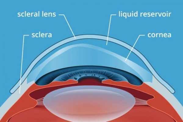 Keratoconus Diagram